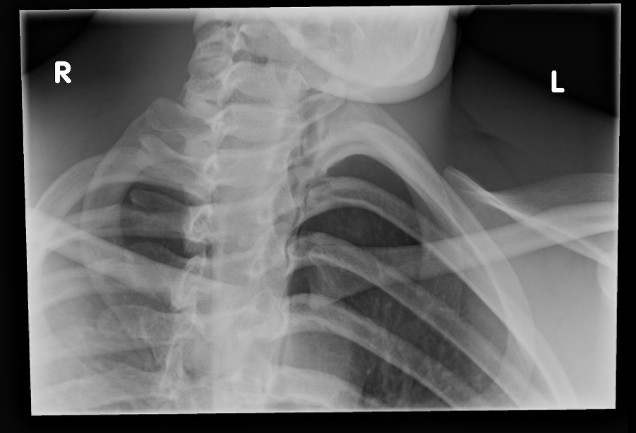 The Daily Educational Pearl Posterior Sternoclavicular Dislocation Emergucate