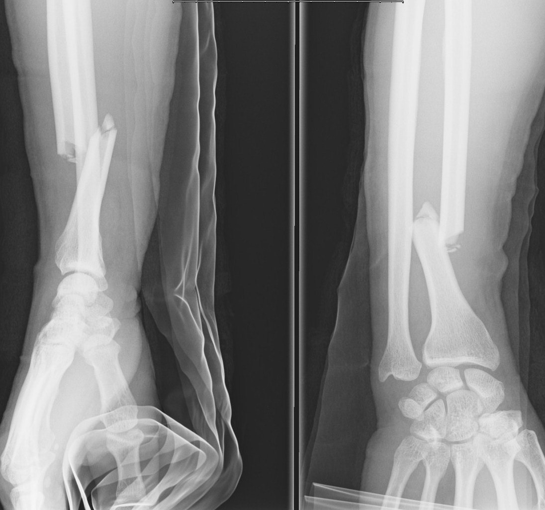 x ray forearm