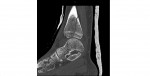 CT of ankle lateral view