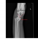 Smith's fracture and DISI