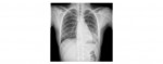 Chest x-ray PA view
