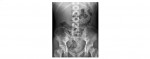 abdominal x-ray