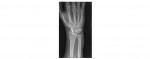 wrist x-ray AP