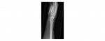 wrist x-ray lateral