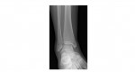 ankle x-ray 1