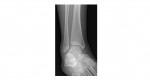 ankle x-ray 2