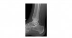 ankle x-ray 3