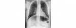 erect chest x-ray
