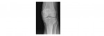 AP knee x-ray