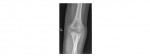 elbow x-ray