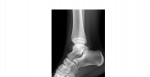 Ankle lateral