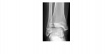 Ankle x-ray 2