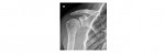 shoulder x-ray 2