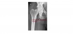 Ischial tuberosity avulsion fracture