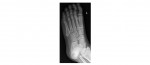 Left foot x-ray