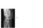 Pisiform fracture