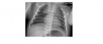 supine chest x-ray