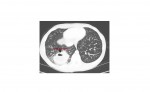 CT lung abscess