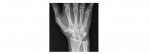 Wrist x-ray