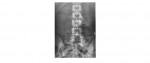 Lumbar spine AP