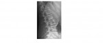 Lumbar spine lateral
