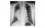 chest x-ray PA view