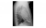 chest x-ray lateral view
