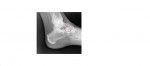 Left ankle healing fracture of anterior process