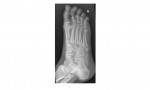 Right foot oblique view