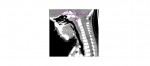 sagittal CT retropharyngeal abscess