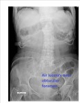 Obturator hernia x-ray