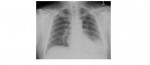 chest x-ray PA