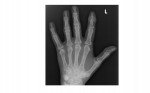 left hand x-ray