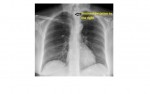 Tracheal indentation on chest x-ray