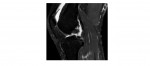 MRI knee 2