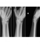 Right wrist x-rays