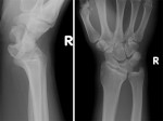 Right wrist x-rays 2