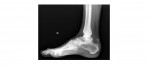 lateral ankle x-ray