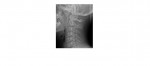 lateral c spine normal