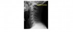 lateral c spine x-ray arcuate foramen