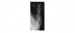 right thumb x-ray