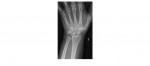 Left wrist x-ray AP