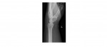 Left wrist x-ray lateral