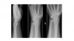Left wrist x-rays