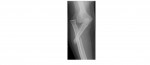 Right forearm and elbow AP x-ray
