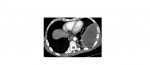 CT chest axial