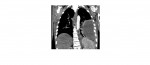 CT chest coronal