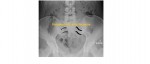 Disrupted left sacral foramina