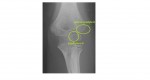 Lateral humeral condyle fracture
