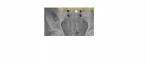 Peliv x-ray normal sacral foramina